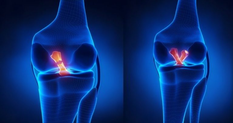 Il legamento crociato anteriore Dott. Carlo Massoni Specialista in